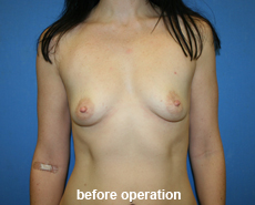 plastic-surgery-breast-augmentation